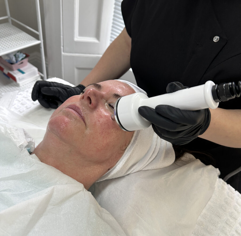 No Needle Mesotherapy In Bolton Emma Coates Skin Clinic